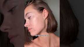 Skin before period 🥹😳#acneproneskin #acne #skincare #skincaretips #noncomedogenic #acnetreatment