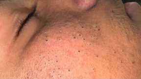 Tranquil Facial Care Routine for Acne & Skin Solutions - ASMR Cleansing