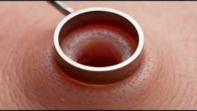 Satisfying Blackhead Removal Compilation | Deep Pore Cleaning ASMR Extreme Blackhead Extraction