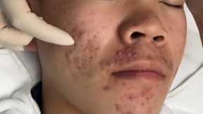 ASMR Acne Treatment | Extreme Blackhead Removal & Skin Cleaning#asmr 