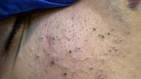 Ultimate Facial Care Routine | Pimple Solutions, Deep Cleansing & Blackhead Removal