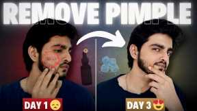 Face Pimples Removal Naturally | 3 DIN ME PIMPLE GAYAB 😱| Acne Treatment at Home | Pimple Treatment