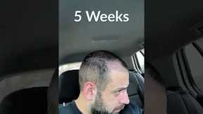 Hair Transplant Process - Week by Week - 3 Months