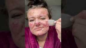 Best Pimple Patch Removals