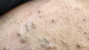 ASMR Facial Care Routine for Acne-Free Skin - Deep Cleansing & Natural Remedies