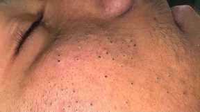 ASMR Facial Care Routine for Clear Skin - Deep Cleansing, Blackhead Removal & Pimple Treatment