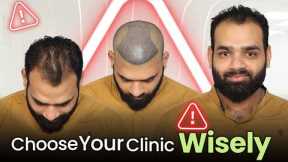 Hair Transplant in Surat (HX-IQPO) | Best Results & Cost of Hair Transplant in Surat.