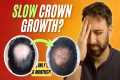 Crown Hair Not Growing? Here’s Why