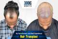 Grade 3 Hair Transplant in India |
