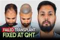 Hair Transplant in Mumbai (HX-QAGG) | 